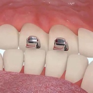 Bite Turbo Dental Ortho Bite Heightening Braces