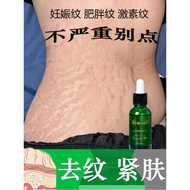 Ready Stock ️ Remove Stretch Marks Postpartum Eliminate Stretch Marks Belly Thigh Growth Marks Remov