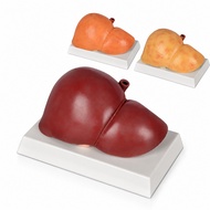 Life Size Silicone Human Liver Model Normal Alcoholic and Non-Alcoholic Fatty Liver Anatomy Patholog