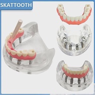 Dental Implant Model with Implant Overdenture Inferior Lower Tooth Implant Removable Model for Denti
