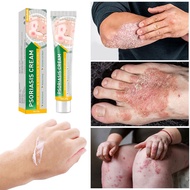 czema cream eczema lotion psoriasis cream湿疹膏 Bacteriostatic /itching/Skin Moss Removal牛皮廯膏 20g