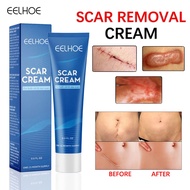 EELHOE Acne Scar Removal Cream Gel Skin Care Stretch Marks Remove Acne Spots Surgical Scars Treatmen