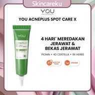 You Acne Plus Spotcare X With Triple UV Mechanism - Acne Spot Treatment