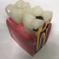 Taoyuan Shipment Dental Tooth Model 6 Times Teeth Comparison Oral Doctor Patient Communication Teach