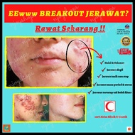 ACNE Krim Jerawat Paling Berkesan Acne Scar Parut Blackhead Whitehead Skincare Set Pimple Kulit Skin