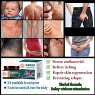 Eczema cream psoriasis ointment for itchy skin 30g antibacterial cream Herbal Antifungal Relief Itch