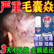 Anti Dandruff Scalp Psoriasis Scalp Treatment Itchy Scalp Seborrheic Dermatitis Spray Ubat Gatal Kul