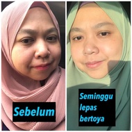 TOYA SERUM (ACNE TREATMENT SERUM)
