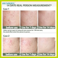 ✧ ⊙    HEMEIEL Sos Pimple Remover/Pimple Marks Acne Spot Treatment/Isotretinoin