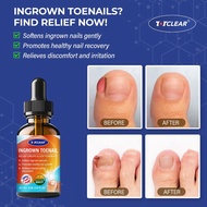 Ingrown Toenail Relief: Ingrown Toenail Tool at Home - Ingrown Toenail Removal Kit - Ingrown Toenail
