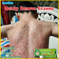 Eczema Treatment Cream 20g Safe all Natural Gamot Sa Kati Kati Sa Balat Bioderm Ointment Fungisol An