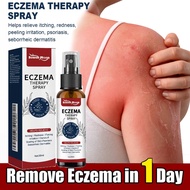 Psoriasis relief spray Scalp, hands, feet, Eczema, Fungus, Anti-itching, Rash, Hives, Scaling remova