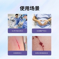 Skin Tension Reducer Wound Scar Healing Surgery Children Postoperative Zipper Wound Sticker Reducing