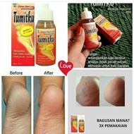 Obat Tumit Pecah Dan Kering Kapalan Pecah2 Parah Obat Tumitku Bpom Manjur