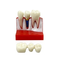 Dental 4 Times Implant Teeth Practice Model Dental Teach Implant Analysis Crown Bridge Removable Mod