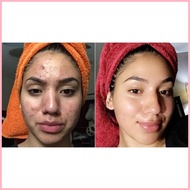✆ ☪ Dr. S. Wong's Bioderm Ointment and Sulfur Soap with moisturizer Anti Acne Remove pimple