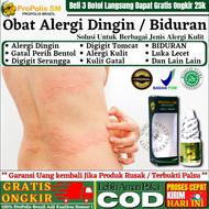 Obat Alergi Dingin Biduran Bentol Perih Panas Bengkak Herbal Alami Untuk Sakit Alergi Kulit Gatal Ku