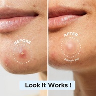 220/large Capacity Mixed Sizes Invisible Acne Patches Pe Material Acne Patches Suitable B1m7