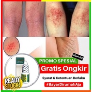 Propolis SM Efficacious For Skin Fungus Itch Medicine/Liquid Ointment For Skin Infection, Removal Of