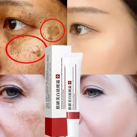 Whitening Freckle Cream Effective Remove Dark Spots Anti Freckle Cream Fade Pigmentation Melasma Bri