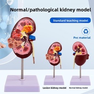 【Fast Shipping】Human Kidney Anatomy Model Diseased Kidney Model Human Organ Anatomy Model Urinary Sy