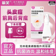 //Acne Removal1Acne Clinacin Phosphate 30ml External Use Clindamycin Phosphate Anti-inflammatory4.3 