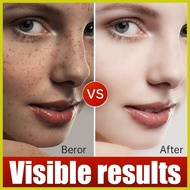➺ ✻ ● Pekas Remover Original 100% Effective Melasma Remover Cream Original Acne Dark Spot Melanin P