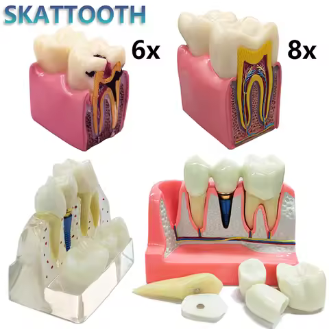 Dental Implant Model 6/8x Magnified Caries Contrast Tooth Model Crown Dental Implant Models for Doct