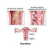 SET RAWAT KEPUTIHAN TERUK/KEPUTIHAN BERBAU/VAGINA GATAL/IKHTIAR HAMIL