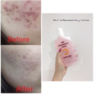 Shiyumi Anti Inflammatory Lotion health beauty skin care face cares control pimples treat allergic s