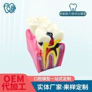 6 Times Contrast Model Dental Teaching Equipment 6 Times Teeth Contrast Model Oral Model Teaching Te