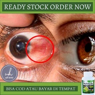 OBAT TRADISIONAL MATA BERLEMAK OBAT UNTUK MATA BERLEMAK OBAT PENYAKIT MATA PTERIGIUM OBAT MATA KERIN