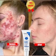 IUALLURE Acne Cream 20g Antibacterial Acne Face Acne Scar Treatment Cream Acne Scar Removal Cream