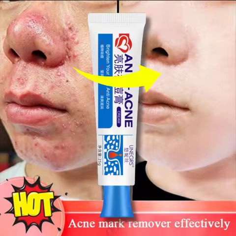 Herbal Acne Removal Face Cream Clears Pimple Scar Black Dots Gel Acne Treatment Shrink Pore Skin Whi