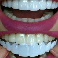 1 Set - Snap On Smile Venners Gigi Palsu Atas Bawah Kuat Makan Pria Wanita Perapi Gigi Tonggos Gingsul Ompong Murah