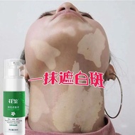 Zhenzhen Nursing Preferred. [Skin Care] Cover White Spots Handy Tool External Use White Spots Skin T