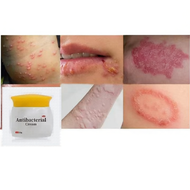 BAIYAOLANG 20g krim kulit krim tulen kanak-kanak dewasa kulit kanan gatal-gatal nyamuk gigitan antib