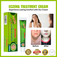 Eczema Treatment Cream Eczema Psoriasis Allergy Antibacterial Skin Fungal Infection Safe and no side