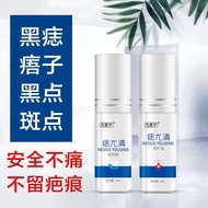 去痣神器点痣药水无痕正品祛痣膏点斑点雀斑学生黑痣脸部取痣Mole Removing Artifact, Mole Removing Potion, No Trace Genuine Product, 