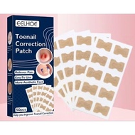 KAYAE Ingrown Toenail Plaster 50pcs Nail Correction Stickers Ingrown Toenail Corrector Paronychia