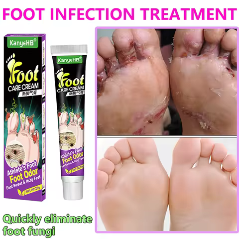 Anti-Foot Fungus Ointment Deodorant Care Products Foot Deodorant Creams Antiseptic and Antiperspiran