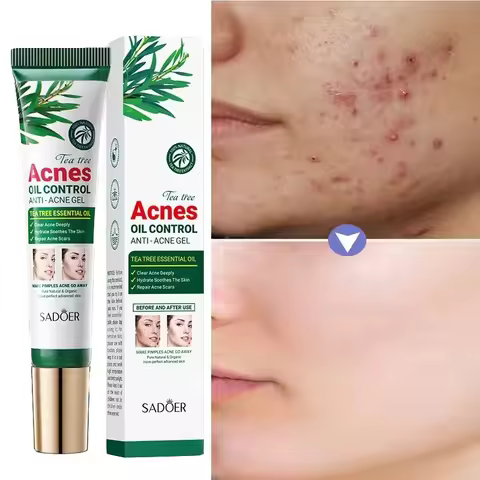 Tea Tree Acne Removing Cream Facial Mild Moisturizing Oil Control Acne Removing Facial Gel Eliminate
