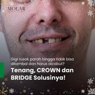 Veneer gigi / crown gigi / gigi pitih / dokter gigi pik/ gigi palsu 