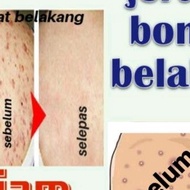 **krim putih kulit,krim jerawat bontot,jerawat punggung,jerawat belakang,bontot hitam,parut punggung