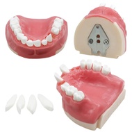 Dental Implant Model Maxillary Missing Resin Bionic Model Implant Practice Model Dental Instrument