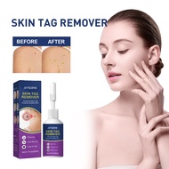 Jaysuing Skin Tag Remover - Pinpoints Skin Tag Protects Healthy Skin 20ml