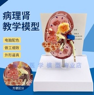 Pathological changes of renal pathological renal kidney model model body dirty anatomize urology med