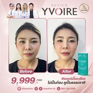 (E-voucher)  ฟิลเลอร์ Yvoire เติมเต็มร่องลึก ไม่เป็นก้อน ลดริ้วรอย