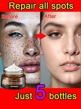 Effective Whitening Freckle Cream Remove Dark Spot Lighten Melasma Melanin Fade Pigmentation Anti Br