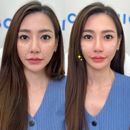 สอบถามคลินิกก่อนกดสั่งซื้อ LBC Clinic โปรเติมฟิลเลอร์ใต้ตา Juvederm 2 cc 2 cc